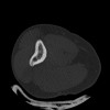SPORK, NICO - 22.03.1976 - 02.08.2022 - CT obere Extremität - 17:51:17